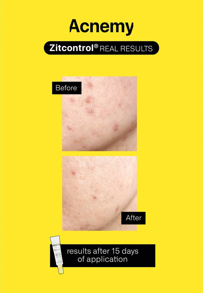 Крем для лечения, уменьшения и профилактики прыщей на лице ACNEMY ZITCONTROL TREATMENT FOR ACNE-PRONE SKIN Крем для лечения, уменьшения и профилактики прыщей на лице ACNEMY ZITCONTROL TREATMENT FOR ACNE-PRONE SKIN