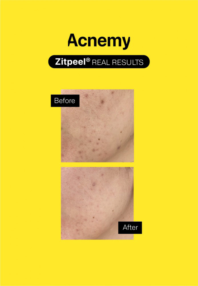 Відлущуючий нічний скраб від прищів ACNEMY ZITPEEL AHA + BHA + PHA SOFT PEELING FOR ACNE-PRONE SKIN Відлущуючий нічний скраб від прищів ACNEMY ZITPEEL AHA + BHA + PHA SOFT PEELING FOR ACNE-PRONE SKIN