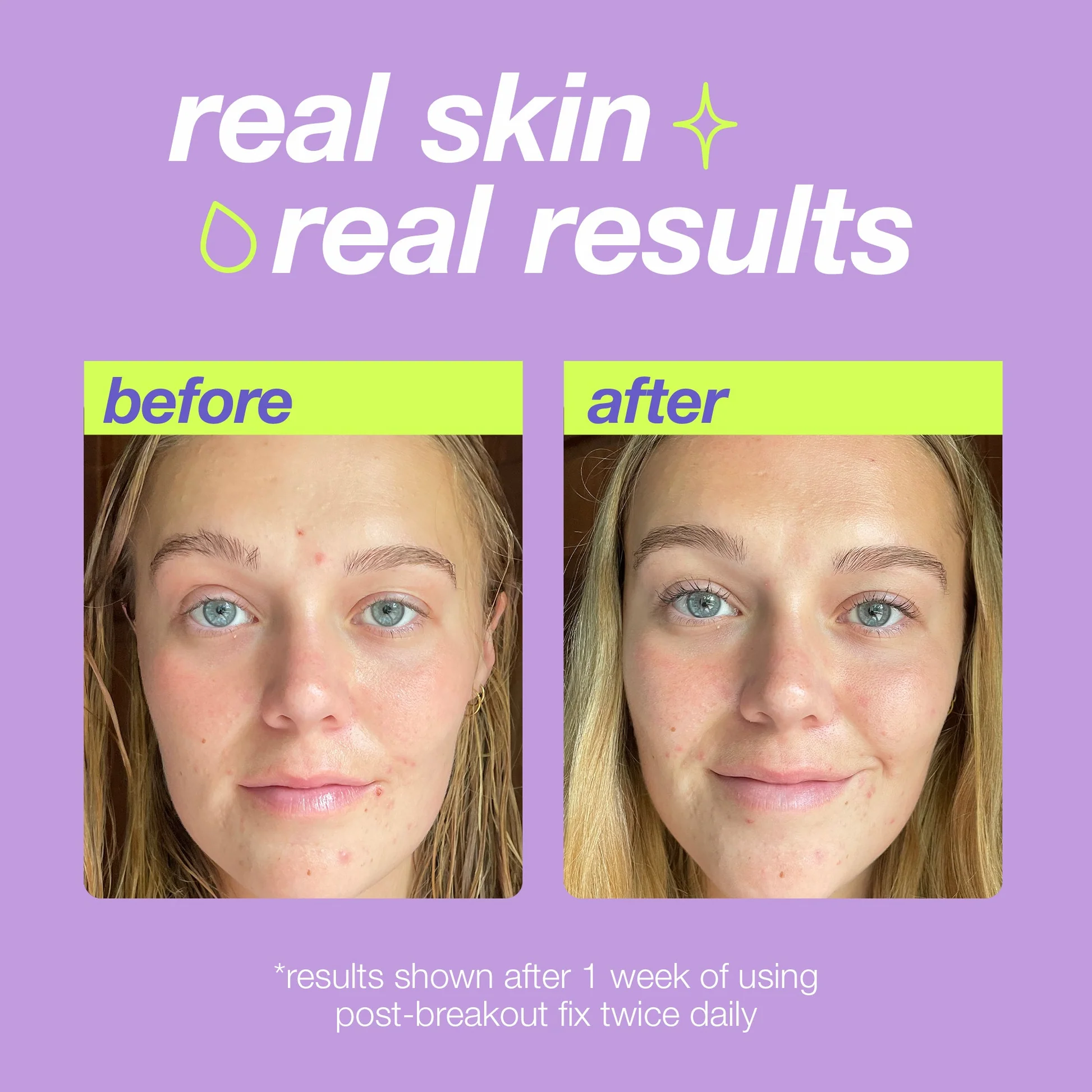 Гель-крем для лечения пятен после высыпаний на лице DERMALOGICA CLEAR START POST BREAKOUT FIX Гель-крем для лечения пятен после высыпаний на лице DERMALOGICA CLEAR START POST BREAKOUT FIX